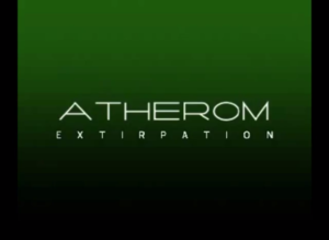 Ateromexstirpation 1