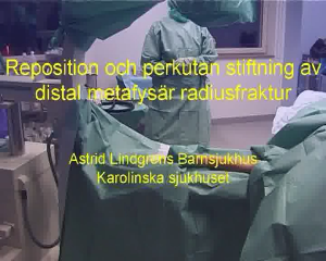 Distal Radiusfraktur, Stiftning (ALB)