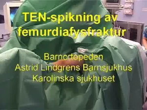 Diafysär Femurfraktur, TEN-spikning (ALB)